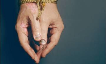 Bezplatné vyšetrenie pre ľudí so psoriázou 27. októbra - Poprad, Sabinov, Prešov, Vranov nad Topľou