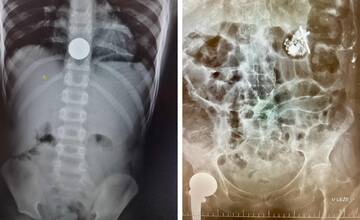 Na urgentnom príjme v Poprade riešia aj kuriozity: Chlapec prehltol dve eurá, seniorka zasa ruženec