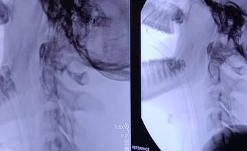 FOTO: Dve unikátne operácie v prešovskej nemocnici počas jedného dňa