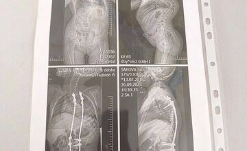 FOTO: Malá Sárka z okresu Prešov trpí zriedkavým genetickým ochorením